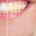Does Teeth Whitening Damage Enamel? An Expert's Perspective