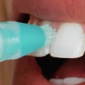 The Best Teeth Whitening Solutions for Fast Results