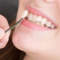 What are the Side Effects of Teeth Whitening?