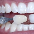 How Much Does Teeth Whitening Cost in South Africa?