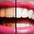 The Best and Safest Ways to Whiten Teeth