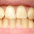 How to Reverse Yellow Teeth and Restore Your Smile