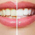 How to Whiten Yellow Teeth in 2-6 Weeks