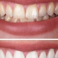 The Pros and Cons of Teeth Whitening