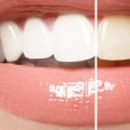 The Ultimate Guide to Teeth Whitening