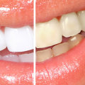 How Much Does Professional Teeth Whitening Cost?