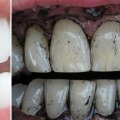 How to Whiten Yellow Teeth and Restore Your Smile