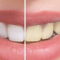 How to Whiten Yellow Teeth with Toothpaste