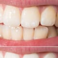 How to Prevent and Treat Teeth Yellowing