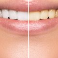 What Are the Long-Term Side Effects of Teeth Whitening?