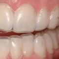 Can Teeth Whitening Damage Your Teeth?