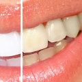 The Safest and Most Effective Way to Whiten Teeth