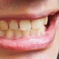 How to Reverse Yellow Teeth Discoloration and Achieve a Perfect White Smile