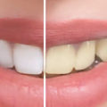 Can Yellow Teeth Become White with Brushing?