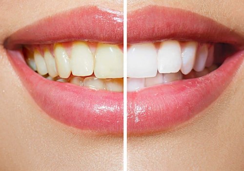 Can Yellow Teeth Become White Again? A Comprehensive Guide