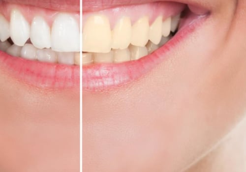 Does Teeth Whitening Damage Enamel? An Expert's Perspective