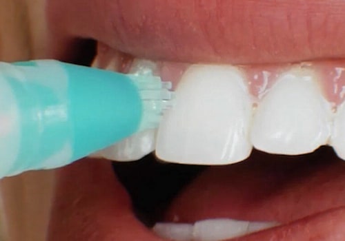 The Best Teeth Whitening Solutions for Fast Results