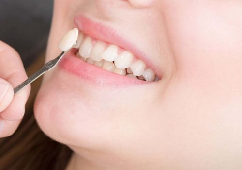 What are the Side Effects of Teeth Whitening?