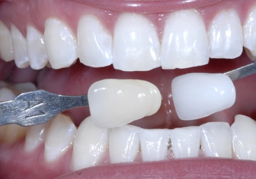 How Much Does Teeth Whitening Cost in South Africa?