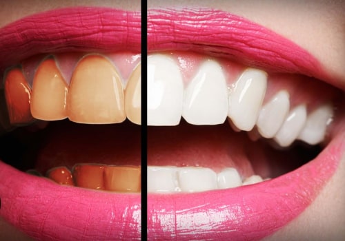 The Best and Safest Ways to Whiten Teeth