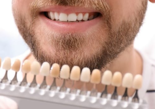 How Long Does Teeth Whitening Last?