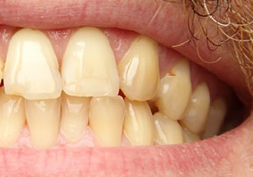 How to Reverse Yellow Teeth and Restore Your Smile