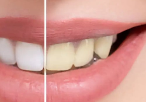 How Long Does It Take for Yellow Teeth to Turn White Again?
