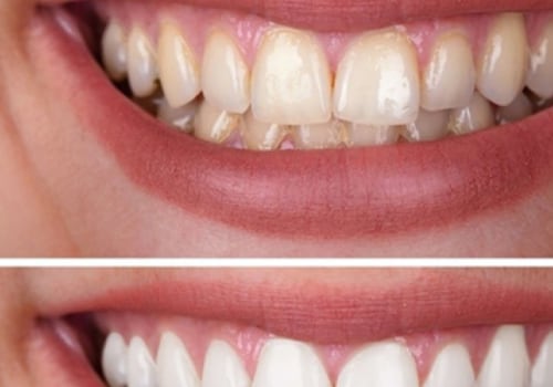 The Pros and Cons of Teeth Whitening