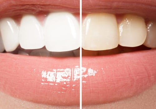 The Ultimate Guide to Teeth Whitening