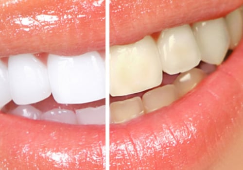 How Much Does Teeth Whitening Cost Near Me?