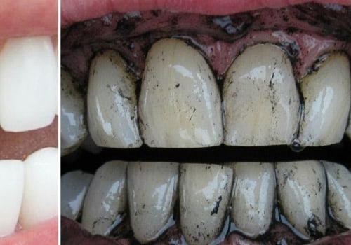 How to Whiten Yellow Teeth and Restore Your Smile