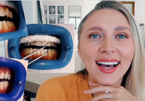 Does Teeth Whitening Damage Your Teeth?