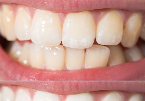 How to Prevent and Treat Teeth Yellowing