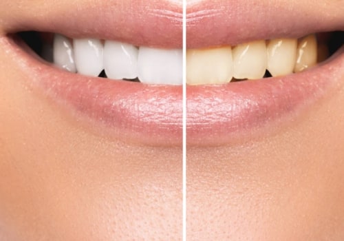 What Are the Long-Term Side Effects of Teeth Whitening?