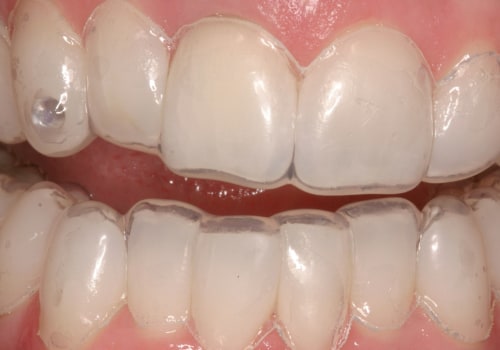 Can Teeth Whitening Damage Your Teeth?