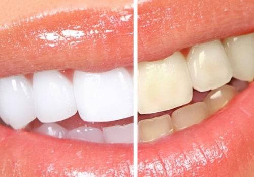 The Safest and Most Effective Way to Whiten Teeth