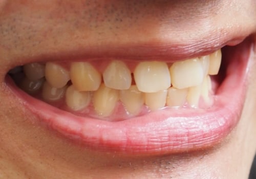How to Reverse Yellow Teeth Discoloration and Achieve a Perfect White Smile